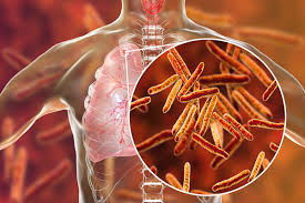 Tuberculose: le Sénégal a enregistré plus de 16000 cas en 2024
