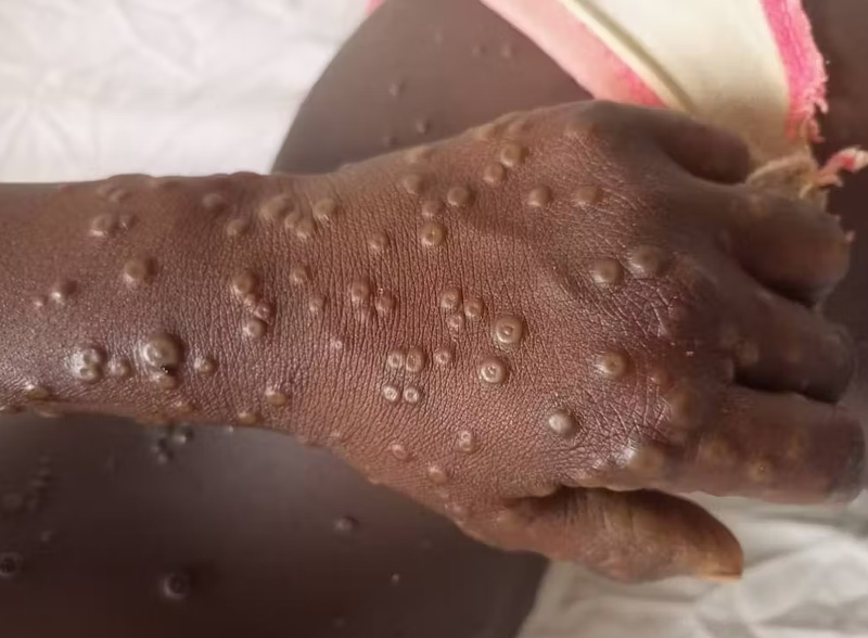 Sénégal : 25 contacts identifiés après le premier cas de variole du singe