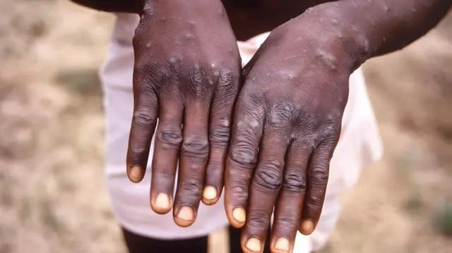 Kolda : renforcement du dispositif de surveillance après le premier cas de mpox au Sénégal Kolda : renforcement du dispositif de surveillance après le premier cas de mpox au Sénégal