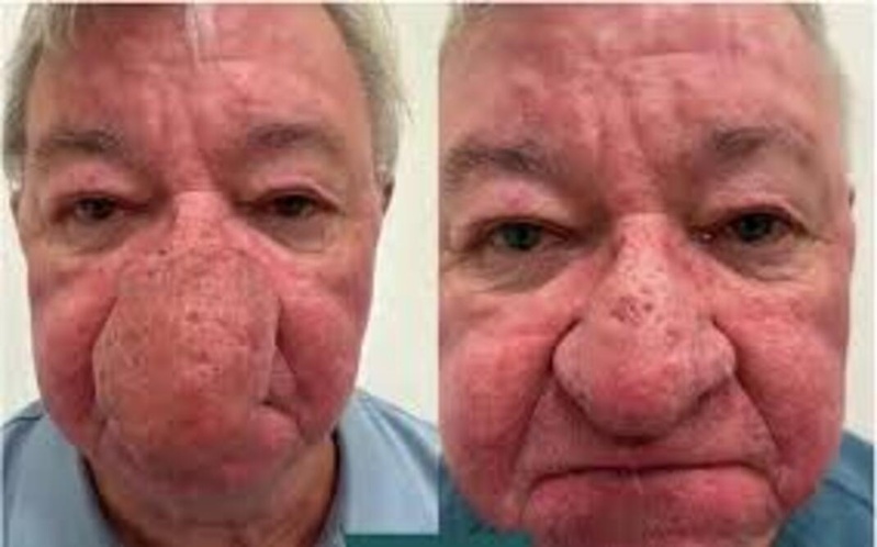 Gérard, victime d’un rhinophyma : « Je ne pouvais plus embrasser ma femme, ni boire une pinte » Gérard, victime d’un rhinophyma : « Je ne pouvais plus embrasser ma femme, ni boire une pinte »