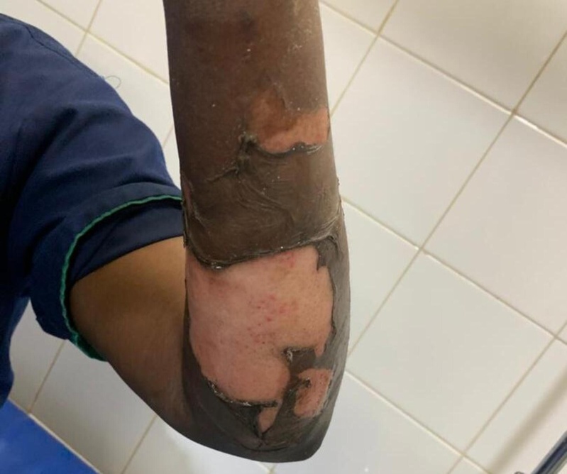 Ngor : A. Ndoye grièvement brûlée à l’eau chaude lors du Navetane