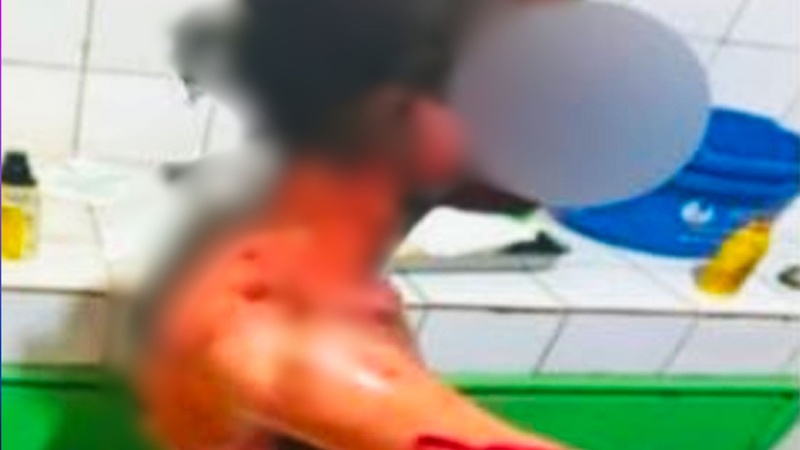 Une adolescente grièvement brûlée lors d’une altercation aux Parcelles Assainies