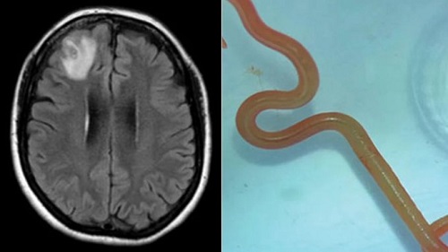 Une Australienne vit plus d'un an avec un ver vivant de 8 cm dans le cerveau