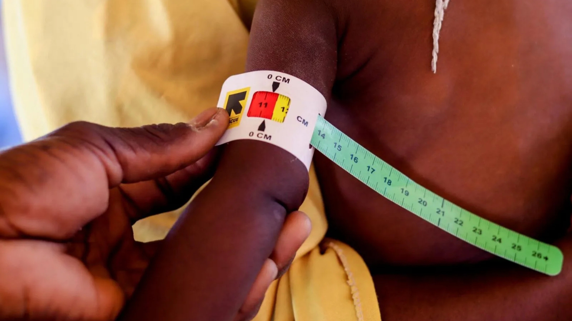 Malnutrition infantile : 1000 cas pris en charge à Diourbel en 2024 selon les autorités sanitaires