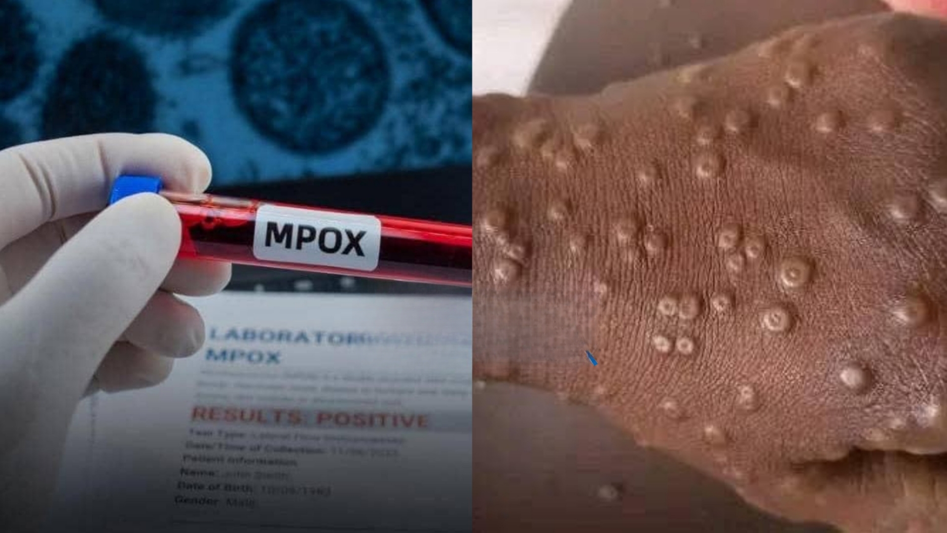 Dakar : un cas de Mpox détecté chez un ressortissant étranger