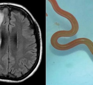 Une Australienne vit plus d'un an avec un ver vivant de 8 cm dans le cerveau