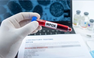 Sénégal : un deuxième cas positif de Mpox confirmé à Dakar
