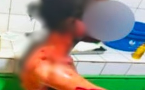 Une adolescente grièvement brûlée lors d’une altercation aux Parcelles Assainies