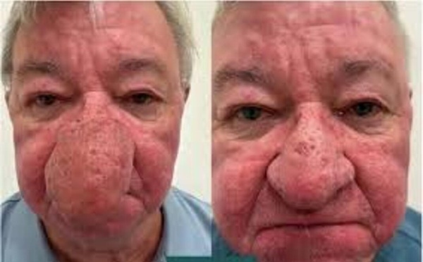 Gérard, victime d’un rhinophyma : « Je ne pouvais plus embrasser ma femme, ni boire une pinte »