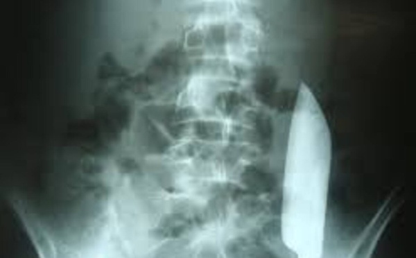 Un patient vit avec une lame de couteau de 15 cm dans le ventre pendant 24h… sans dégâts majeurs !