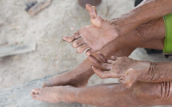 Thiès : la lèpre reste sous contrôle malgré quelques cas enregistrés en 2025