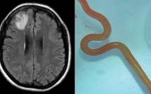 Une Australienne vit plus d'un an avec un ver vivant de 8 cm dans le cerveau