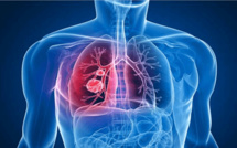 Sensibilisation à Richard-Toll : Formation des acteurs locaux contre la tuberculose