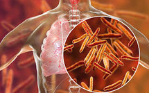 Tuberculose: le Sénégal a enregistré plus de 16000 cas en 2024 Tuberculose: le Sénégal a enregistré plus de 16000 cas en 2024