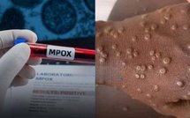 Dakar : un cas de Mpox détecté chez un ressortissant étranger