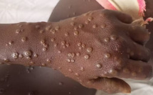 Sénégal : 25 contacts identifiés après le premier cas de variole du singe