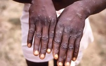 Kolda : renforcement du dispositif de surveillance après le premier cas de mpox au Sénégal