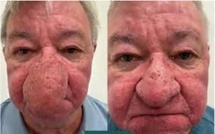 Gérard, victime d’un rhinophyma : « Je ne pouvais plus embrasser ma femme, ni boire une pinte »