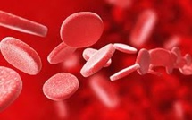 Santé : Un traitement innovant et abordable pour lutter contre la drépanocytose au Sénégal