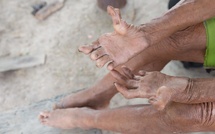 Thiès : la lèpre reste sous contrôle malgré quelques cas enregistrés en 2025